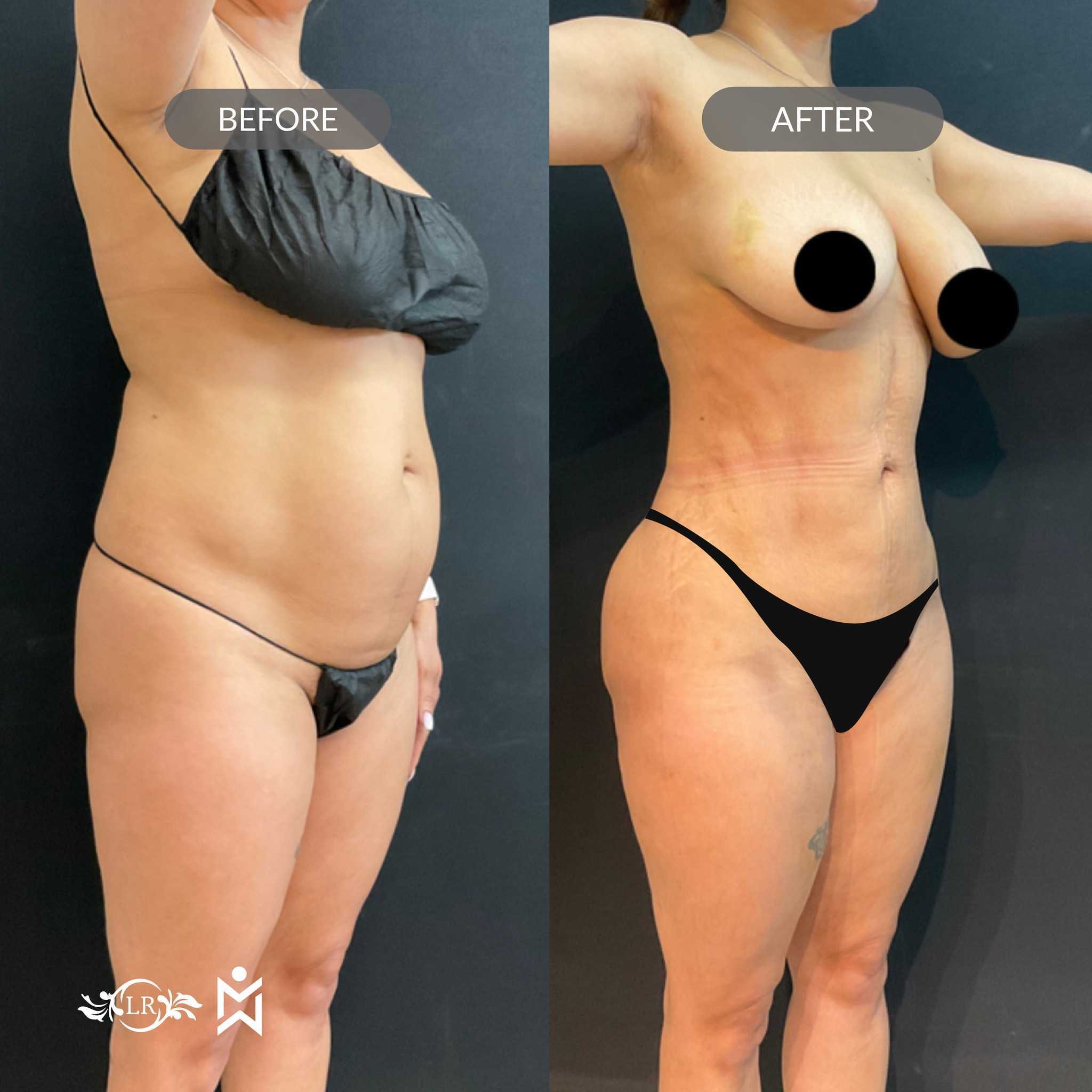 Abdominoplastia en Santo Domingo, República Dominicana