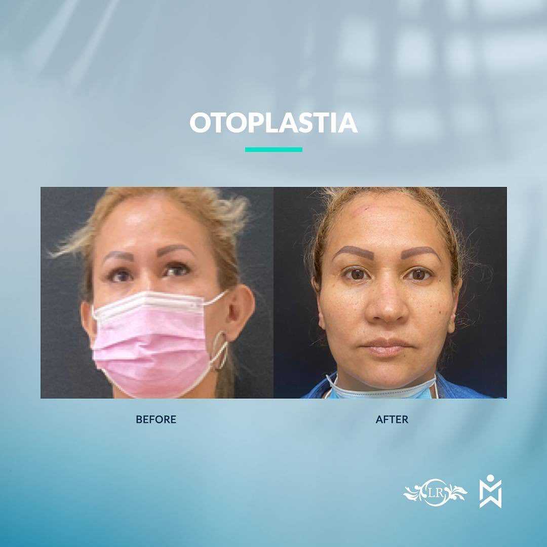 Cirugía de Orejas en Santo Domingo República Dominicana Antes y Después