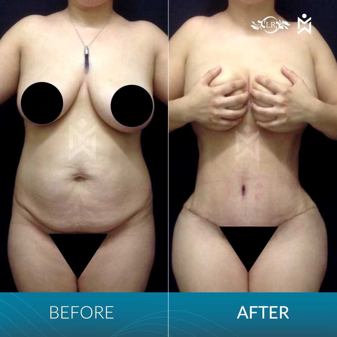 Reducción de Senos en Santo Domingo República Dominicana Antes Después