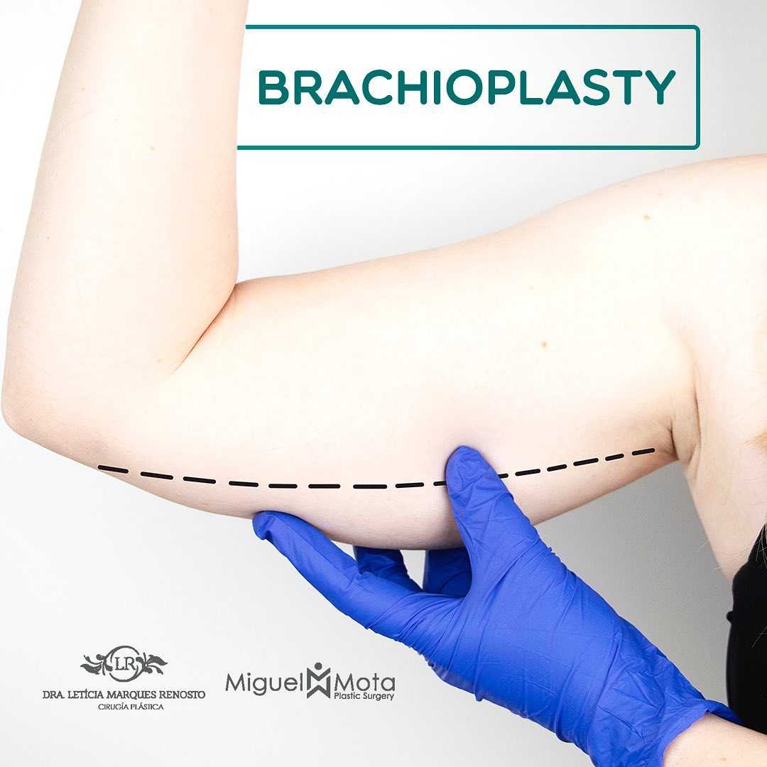 Cirugía de lifting de brazos en Santo Domingo, República Dominicana
