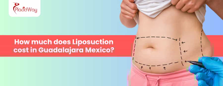 Costo de la liposucción en Guadalajara, México
