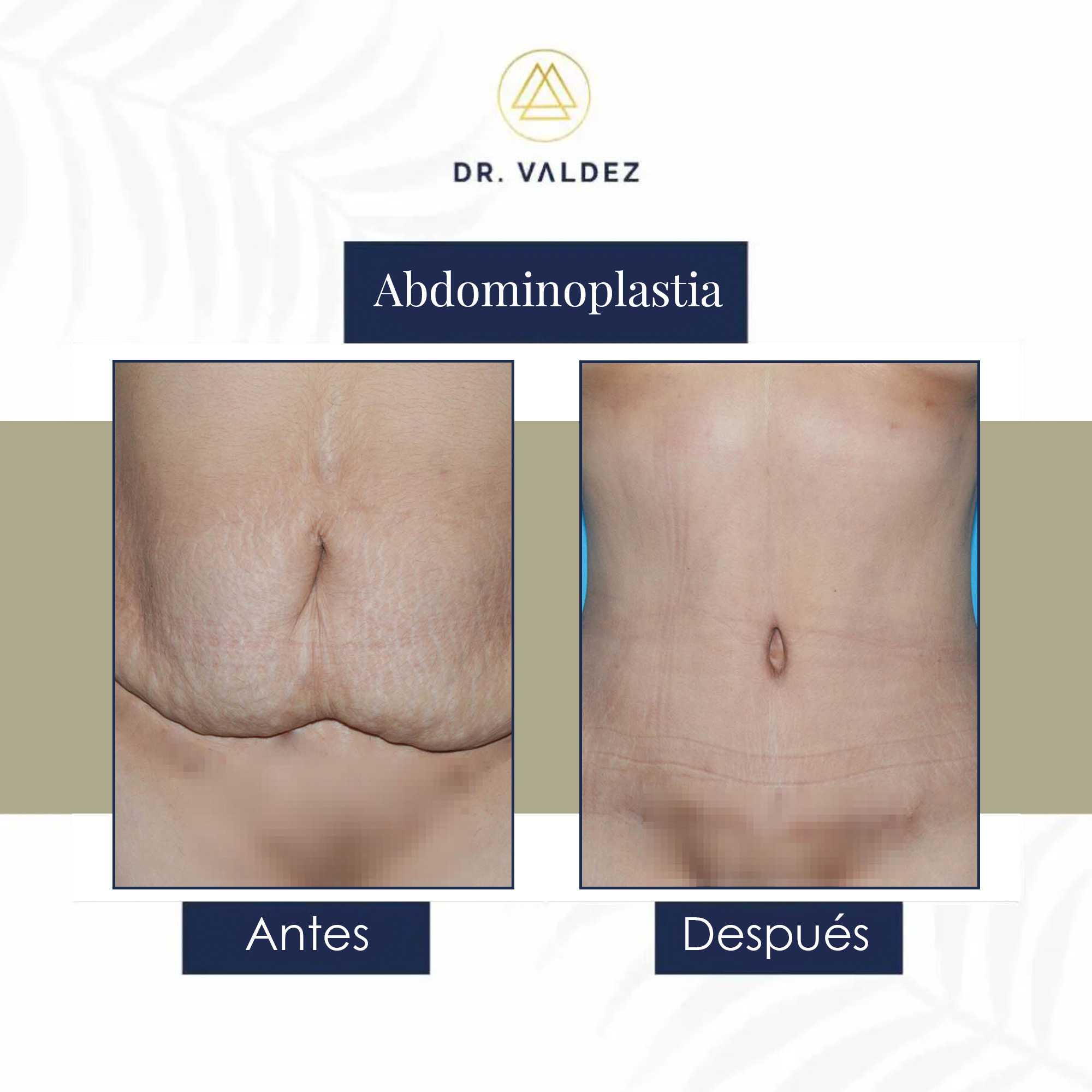 Abdominoplastia en Cancún México
