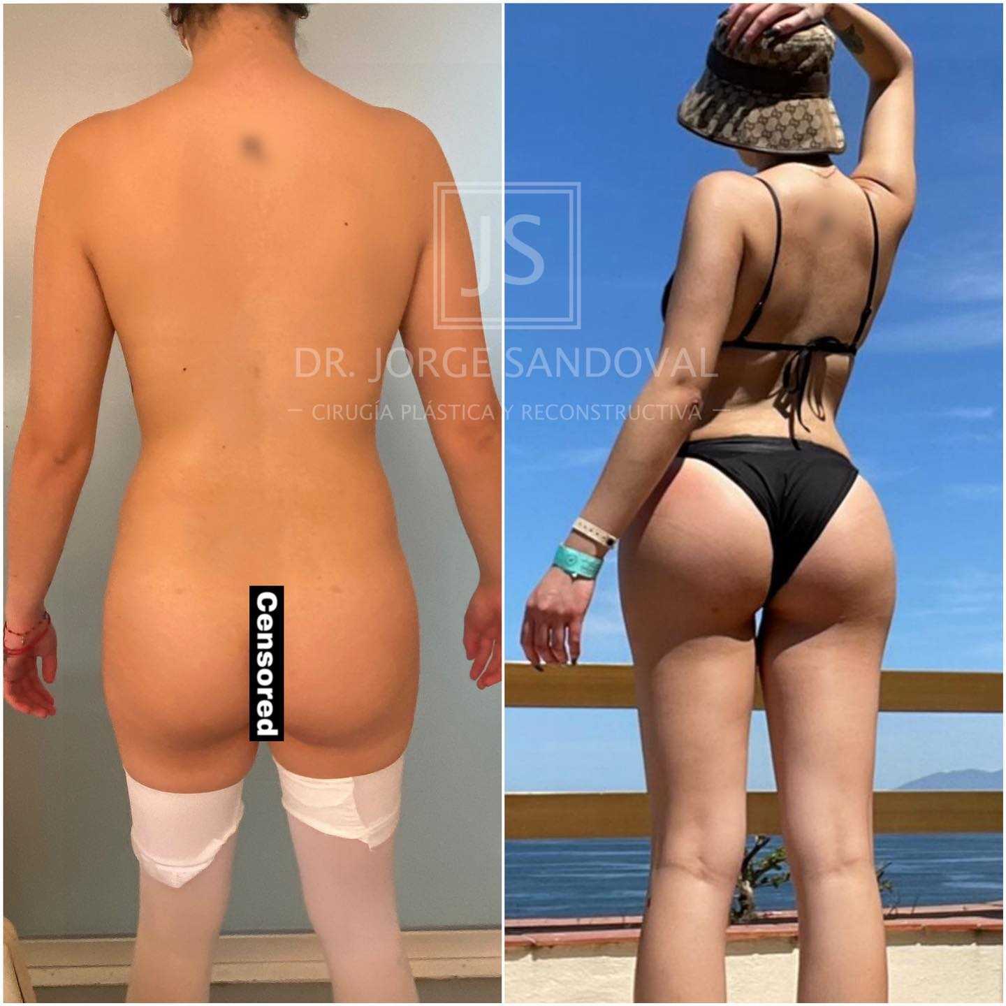 Before and After Image for Brazilian Butt Lift in Mexico City, Mexico
