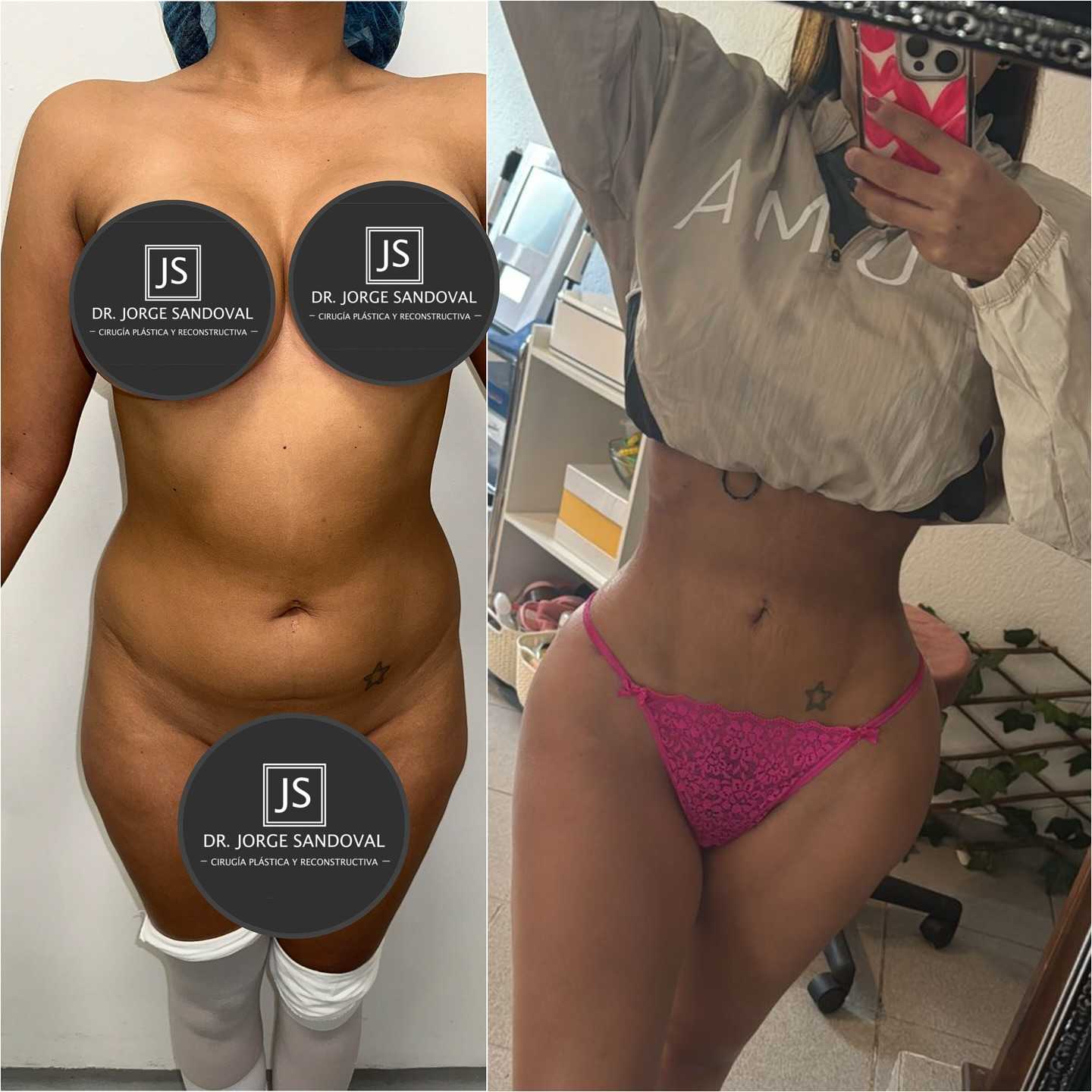 Before and After Image for Breast Augmentation in Mexico City, Mexico
