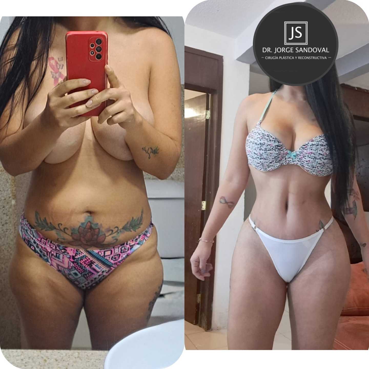 Before and After Image for Liposuction in Mexico City, Mexico