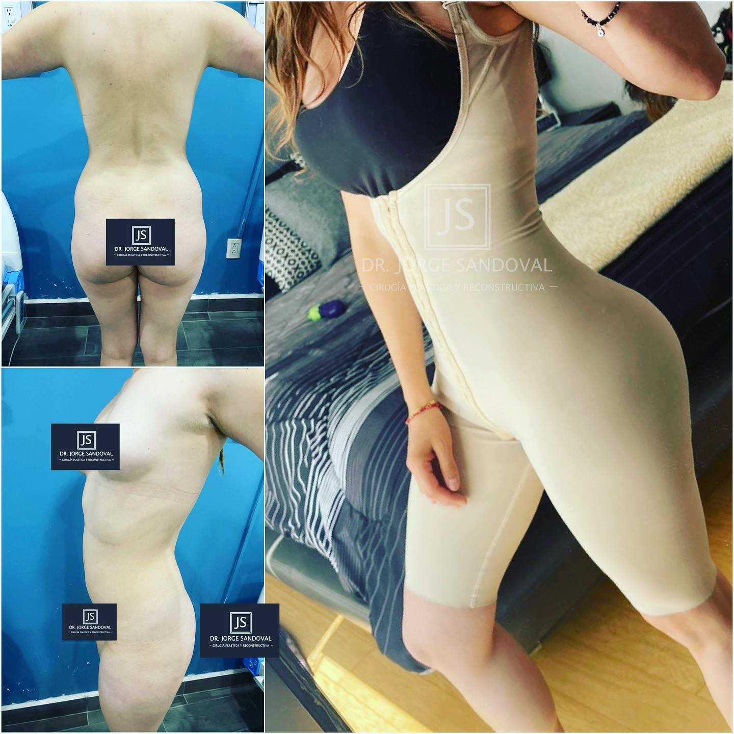 Before and After Image for Mommy Makeover in Mexico City, Mexico