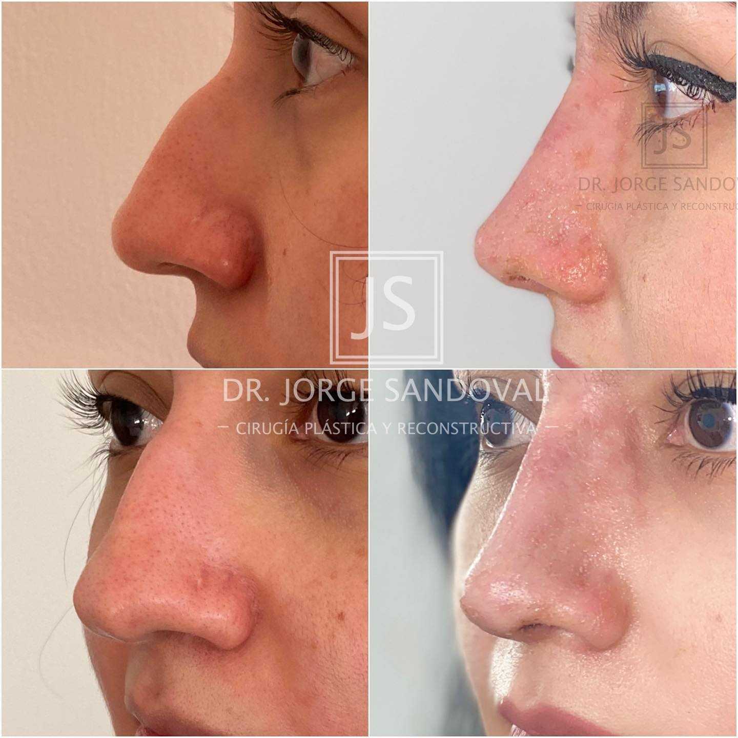 Before and After Image for Rhinoplasty in Mexico City, Mexico