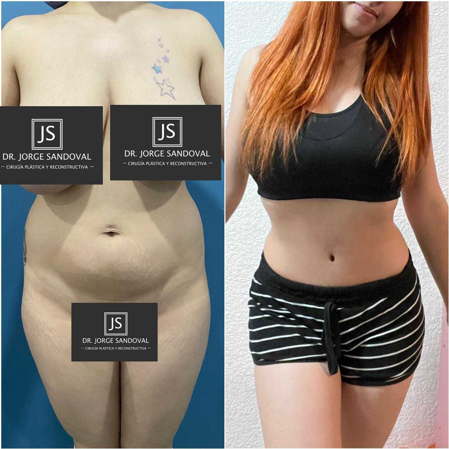 Before and After Image for Tummy Tuck in Mexico City, Mexico