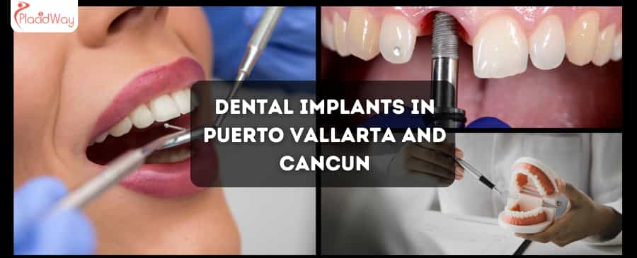 Implantes dentales en Puerto Vallarta y Cancún: cómo los canadienses ahorran en atención dental mientras disfrutan de sus vacaciones
