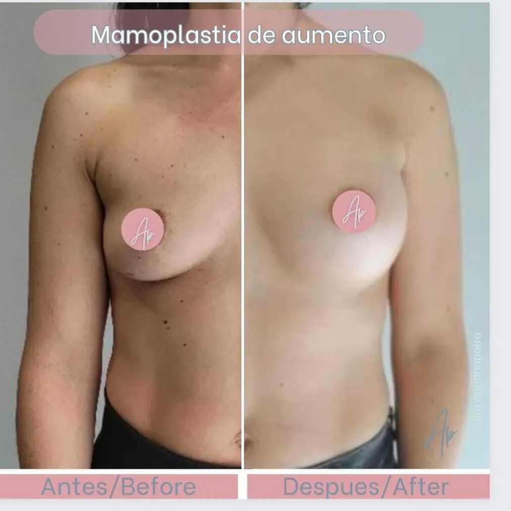 Antes y después de una reducción de senos en Bogotá, Colombia