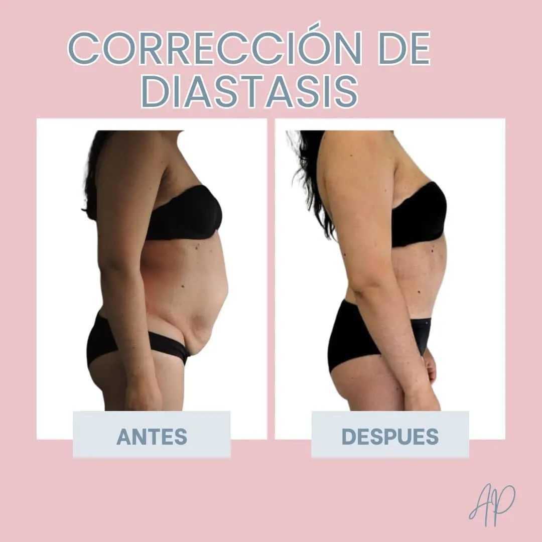 Antes y después de una abdominoplastia en Bogotá, Colombia