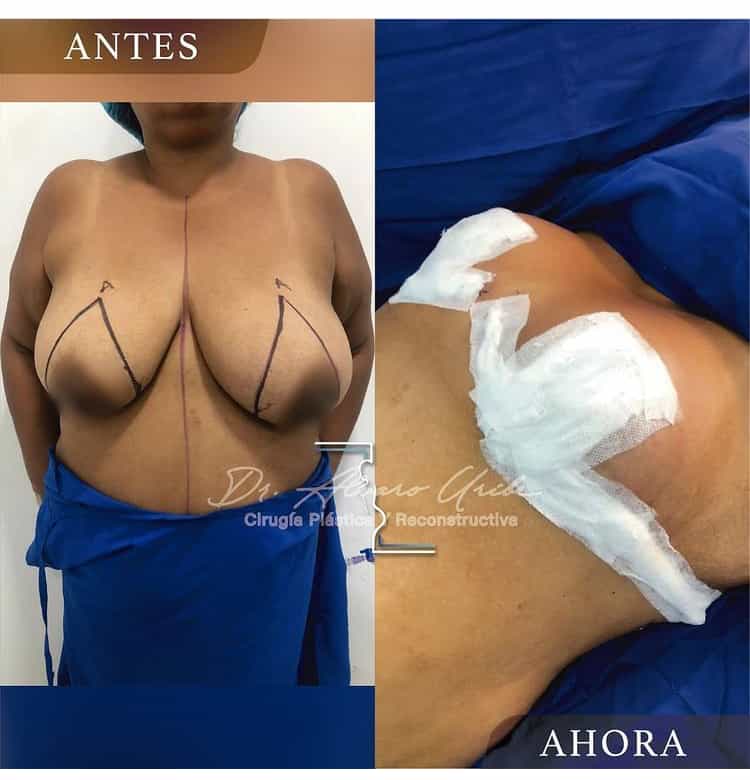 Breast Reduction Colombia