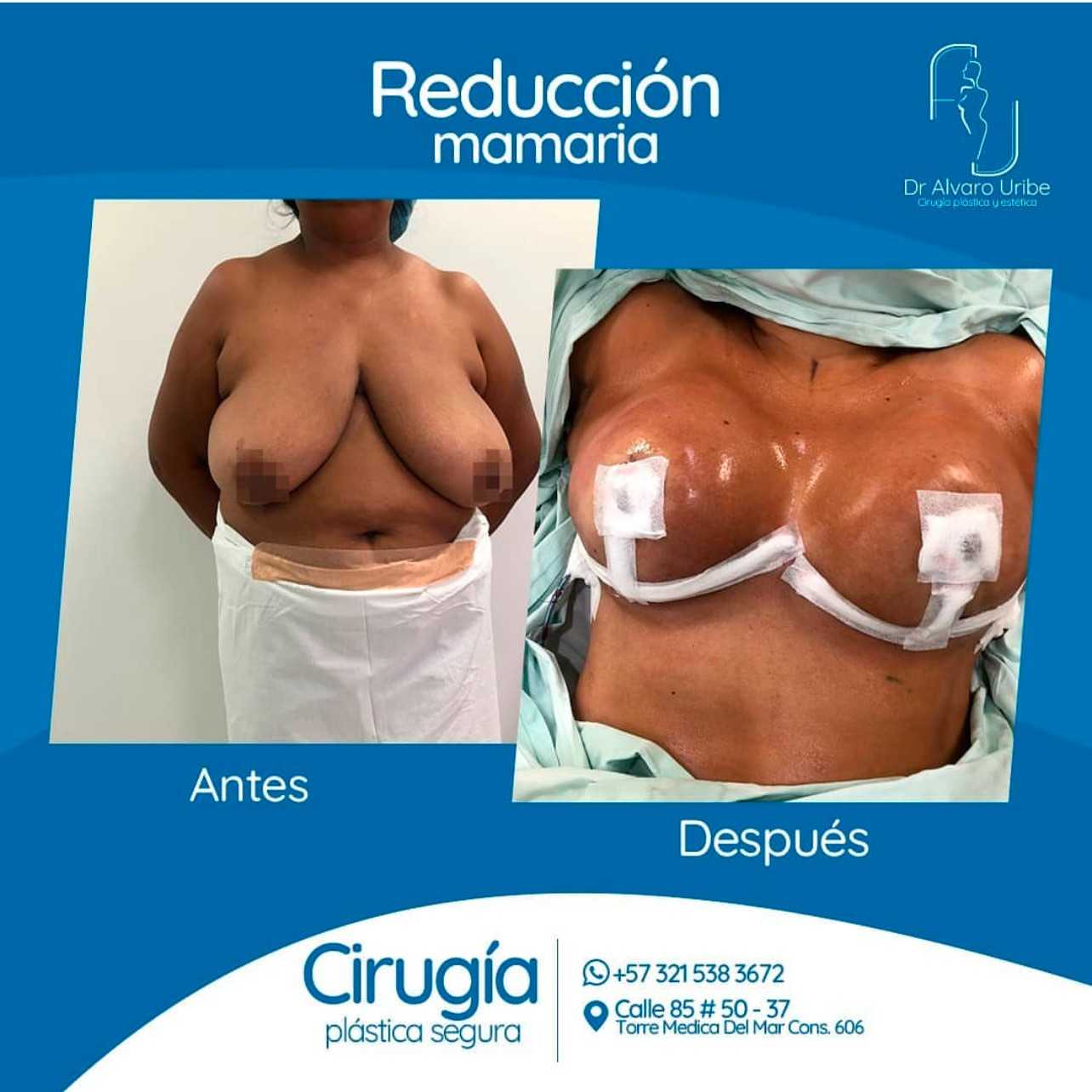 Breast Reduction Without Implants Colombia