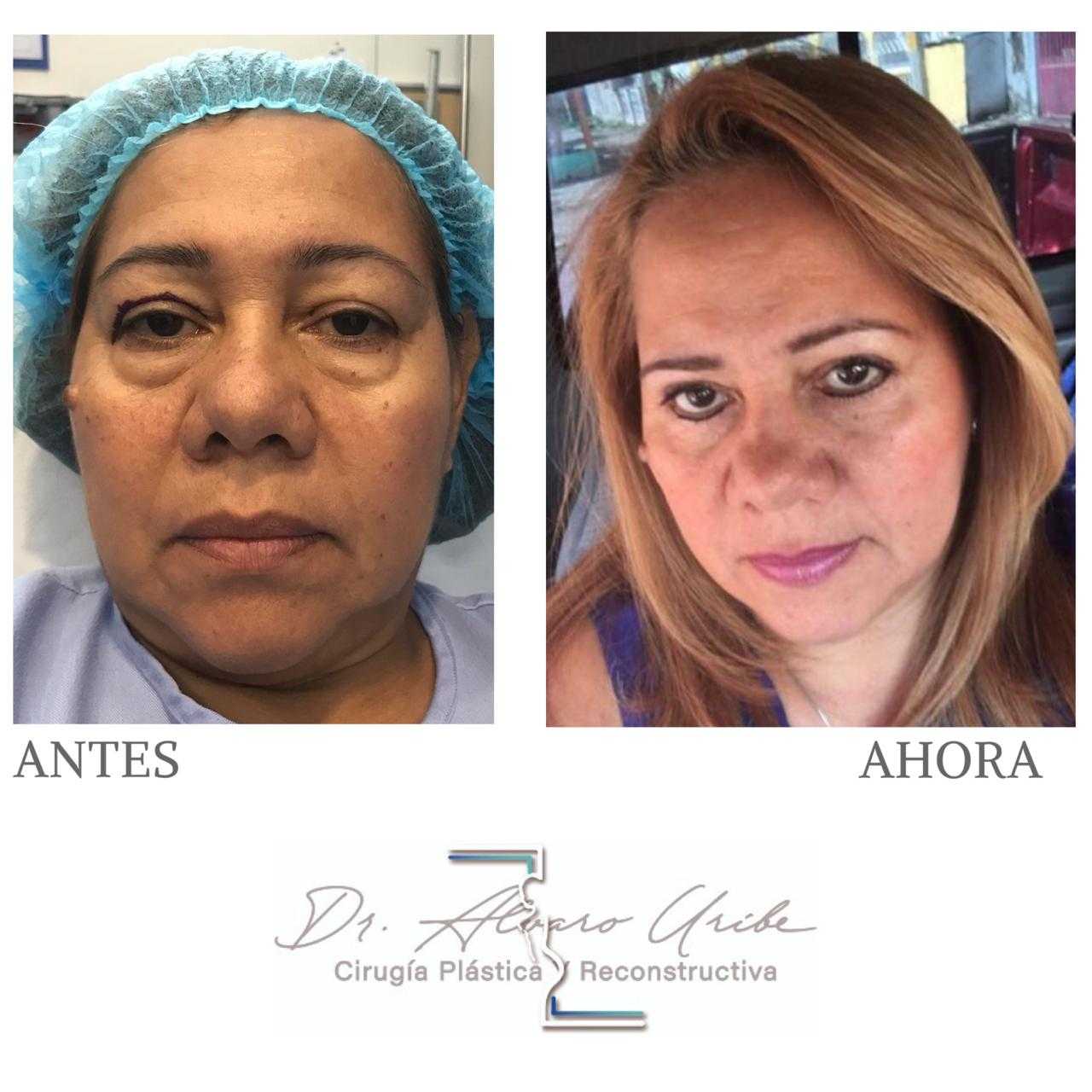 Eyelid Surgery in Colombia