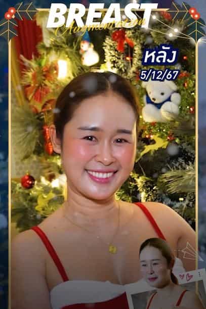 زراعة الثدي في بانكوك، تايلاند - قصة ناه