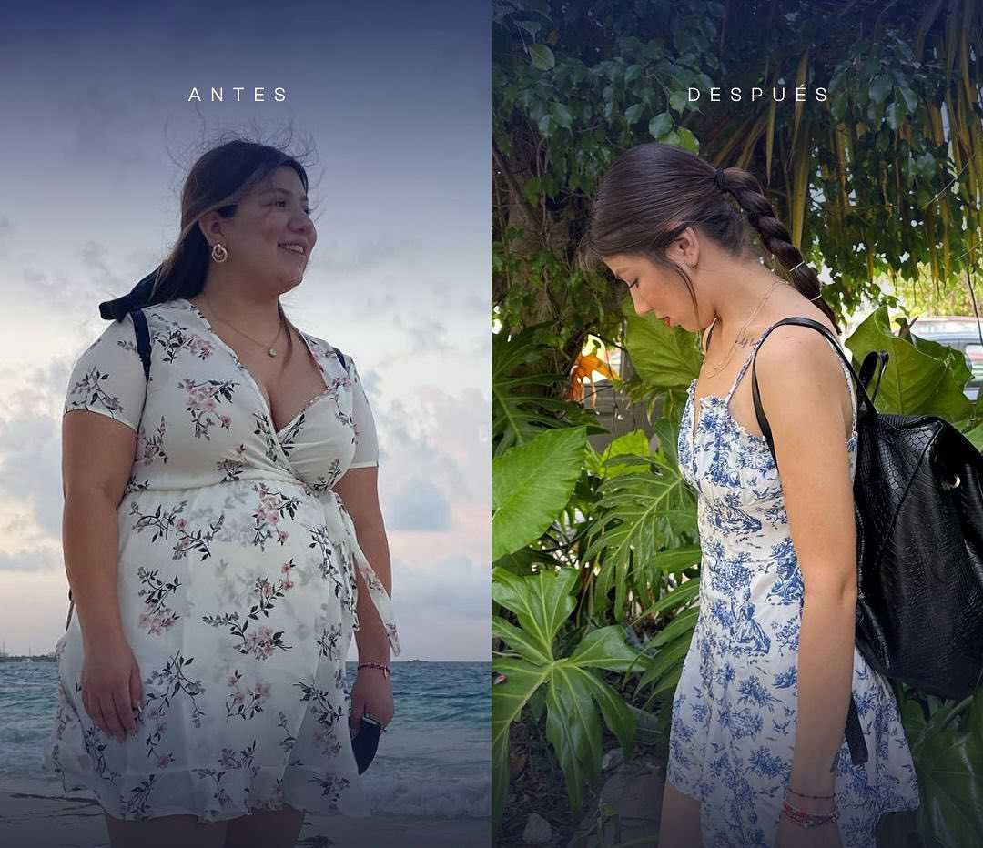 Imágenes de antes y después de cirugía bariátrica en Mexicali, México