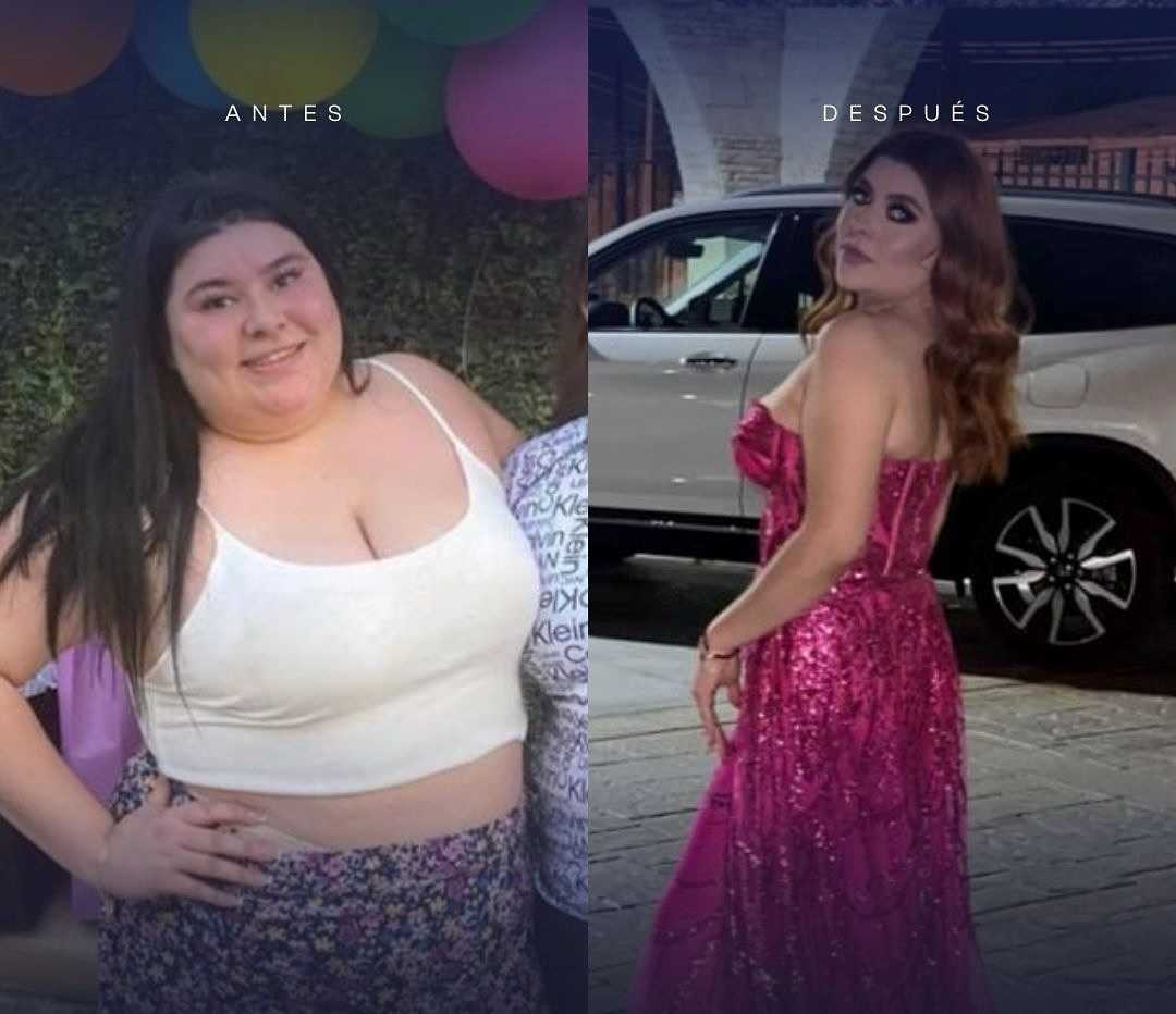 Imagen de antes y después de balón gástrico en Mexicali, México