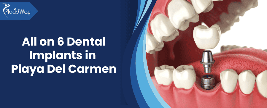 All On Dental Implants Clinics In Playa Del Carmen