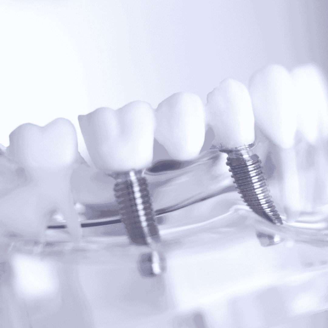 Titanium Dental Implants