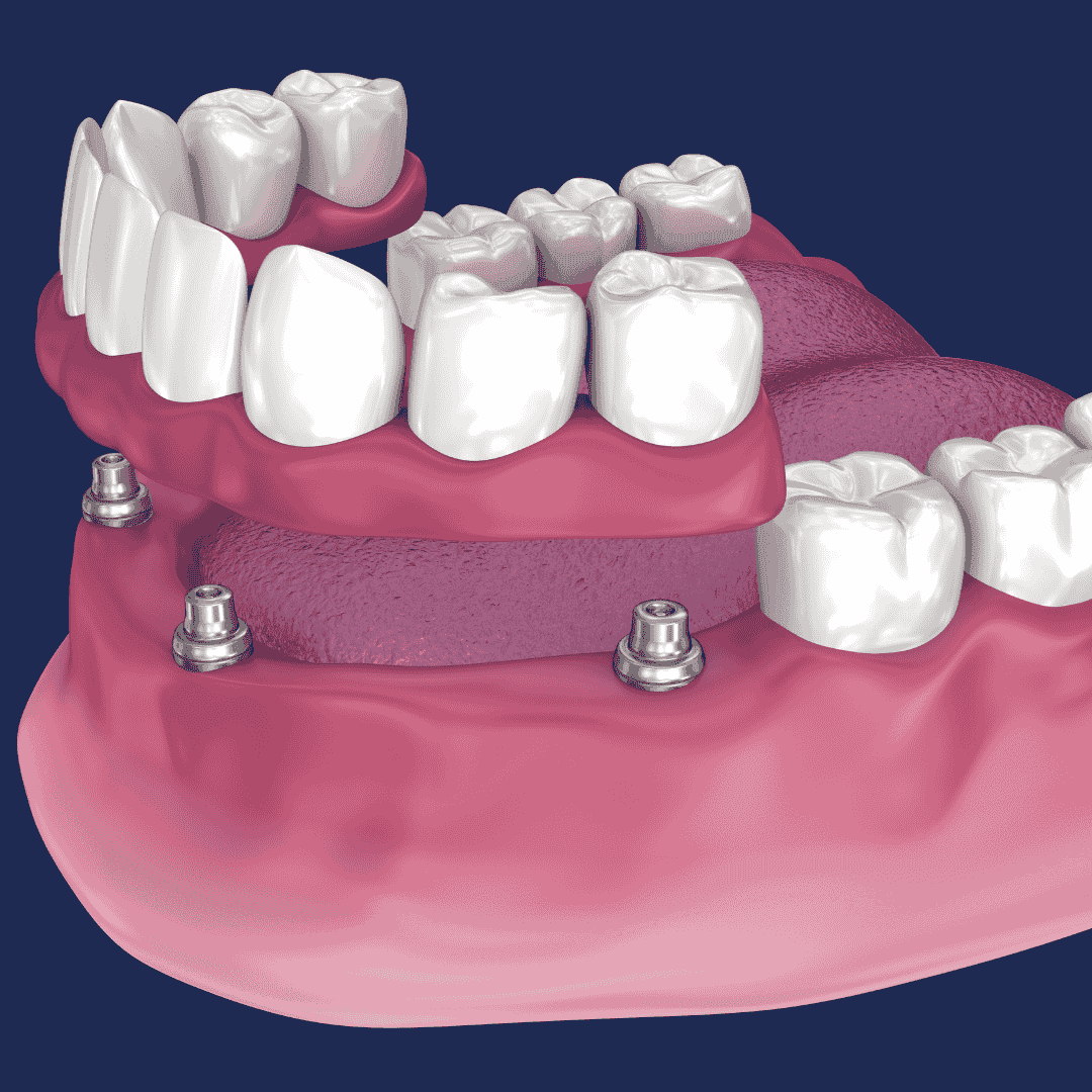 All on 4 Dental Implants