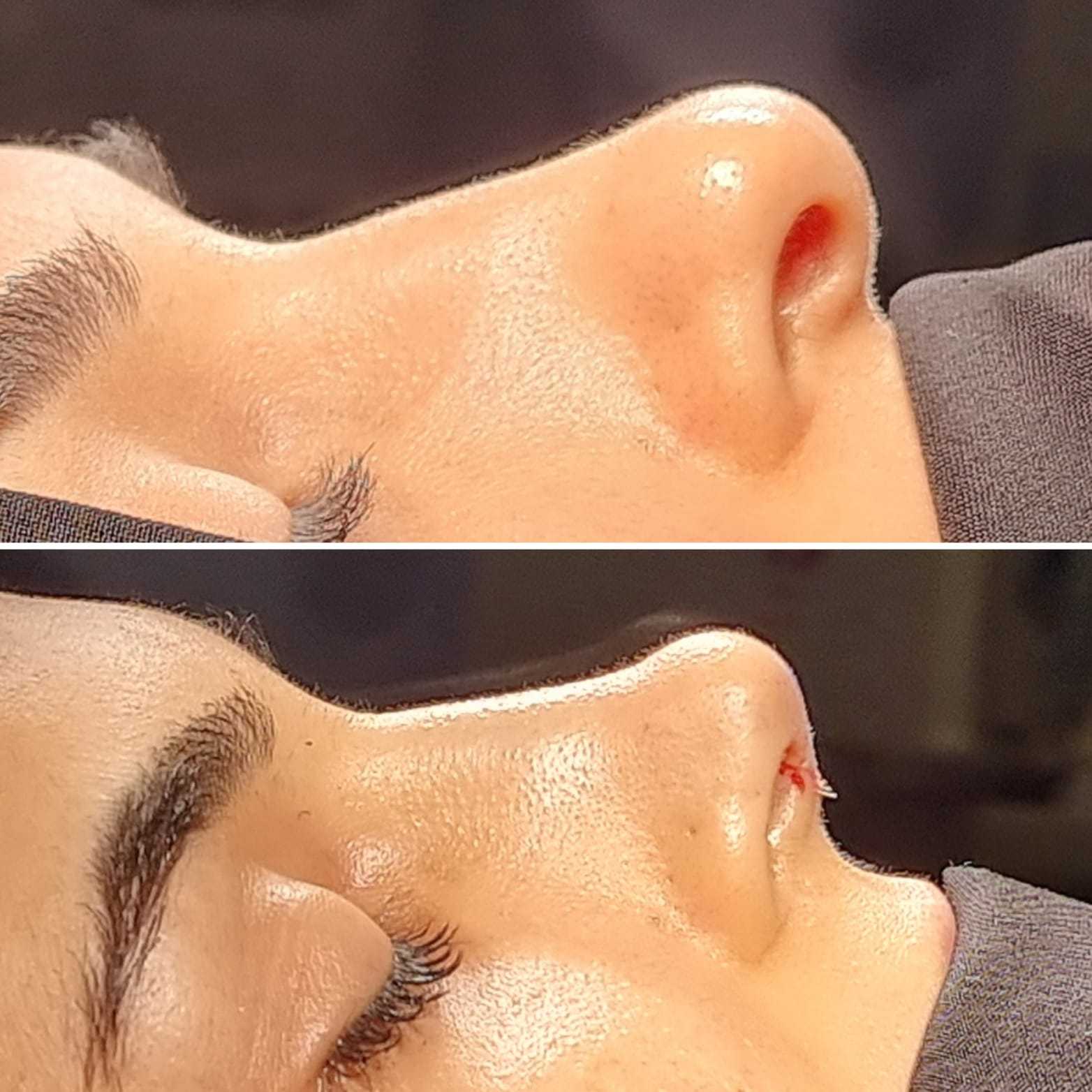 Nasenkorrektur in Antalya, Türkei Vorher und Nachher