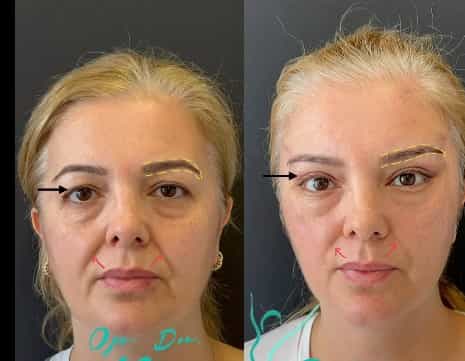 Facelift-Transformation Antalya, Türkei