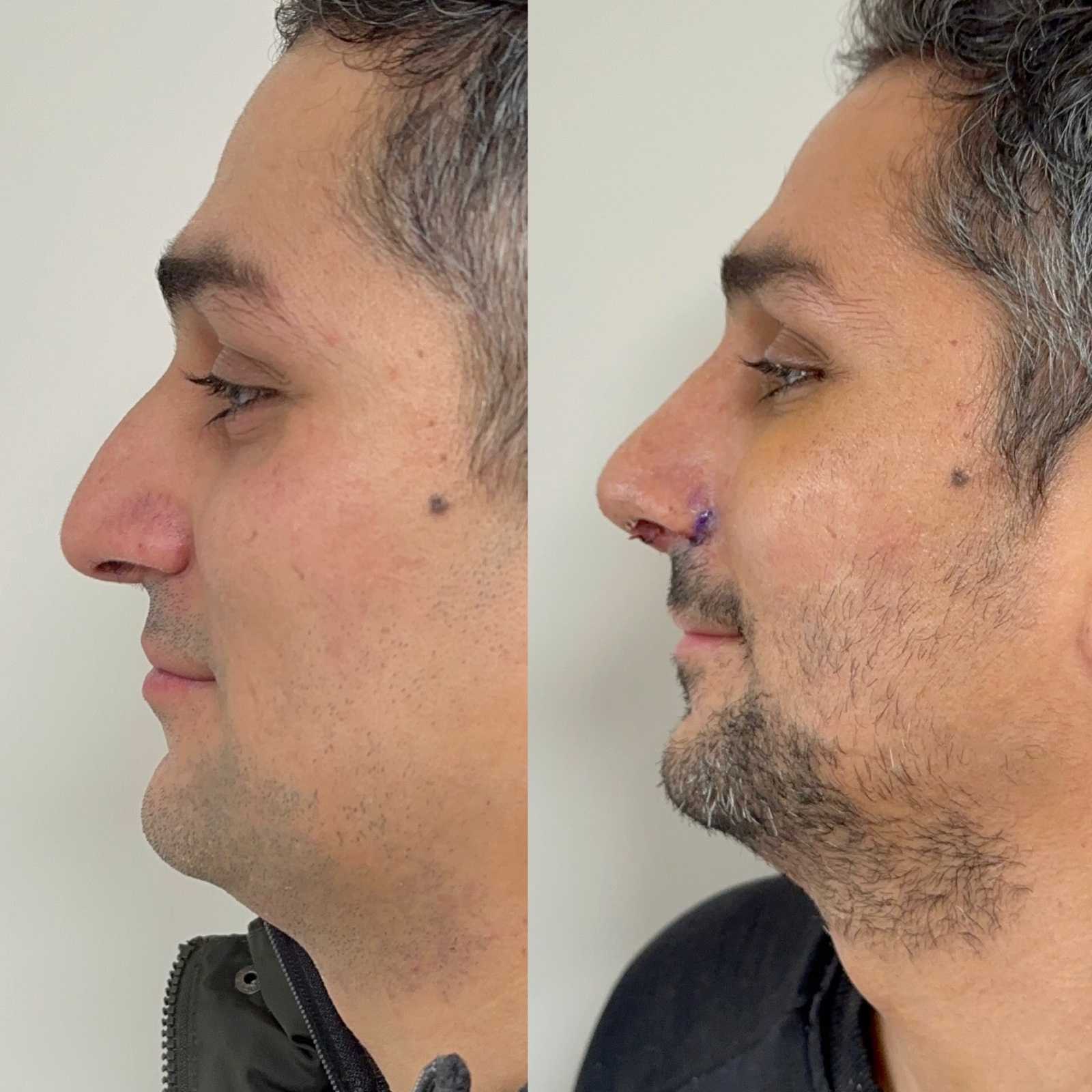 Antalya Nasenkorrektur Vorher & Nachher