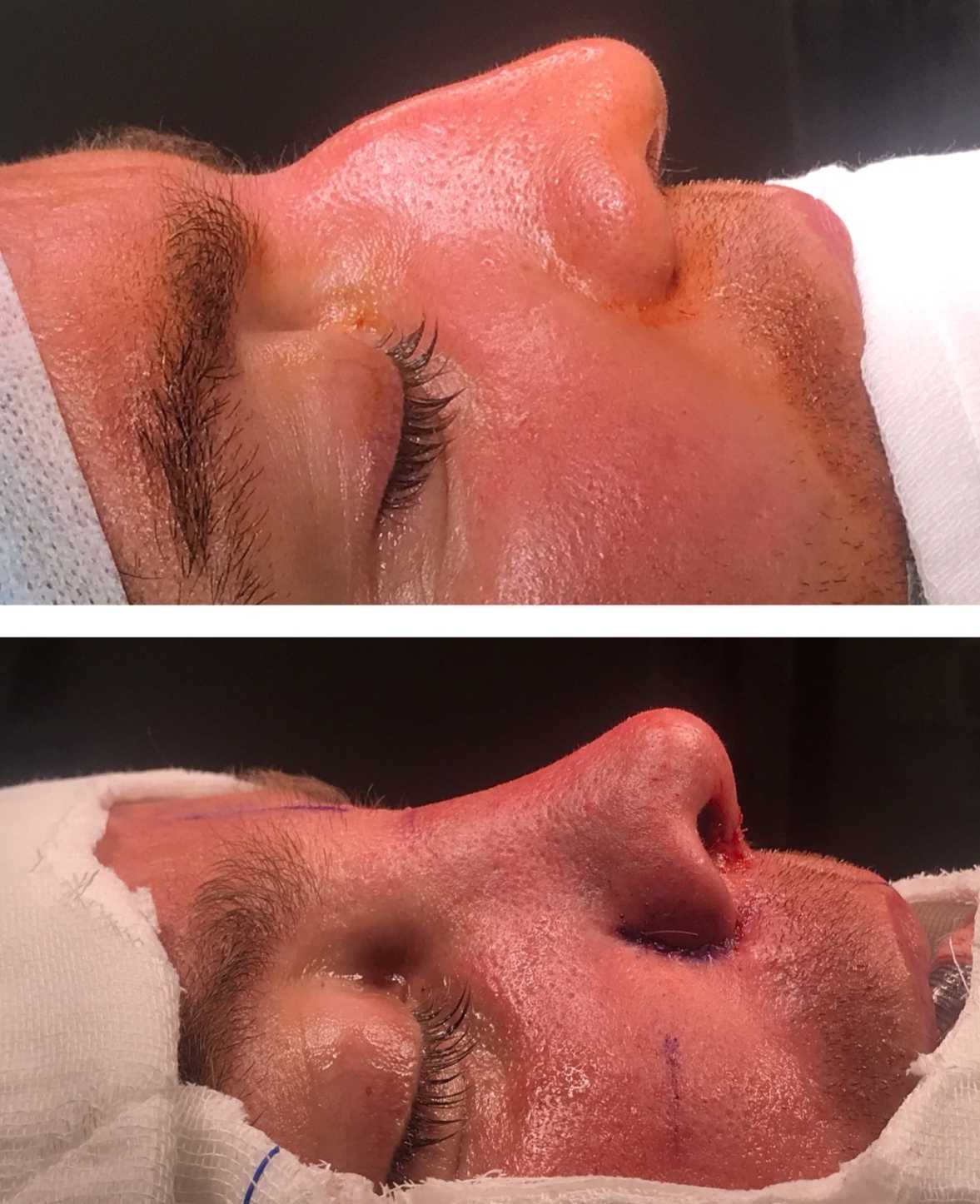 Vorher & Nachher Nasenkorrektur Antalya