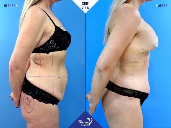 Bauchdeckenstraffung in Antalya – Vorher & Nachher