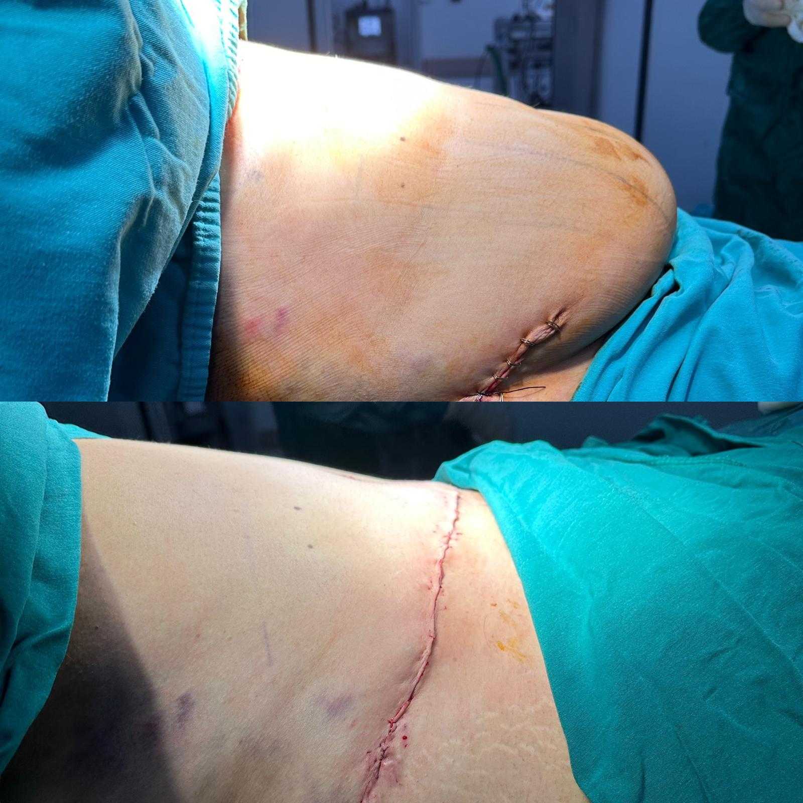 Vorher & Nachher Bauchdeckenstraffung Antalya