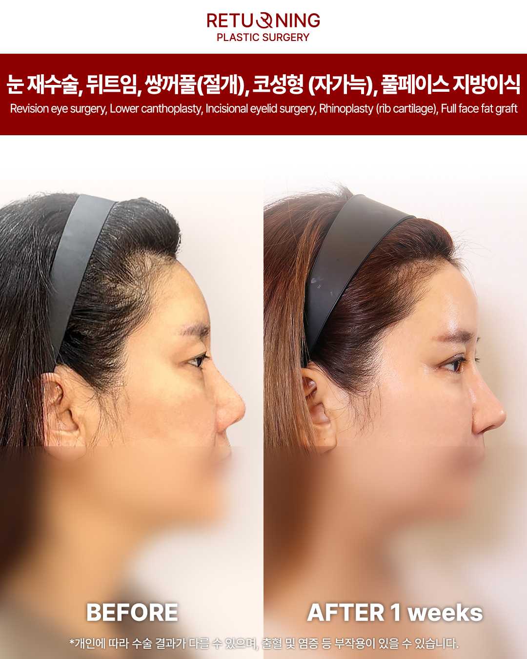 Ринопластика: фото до и после