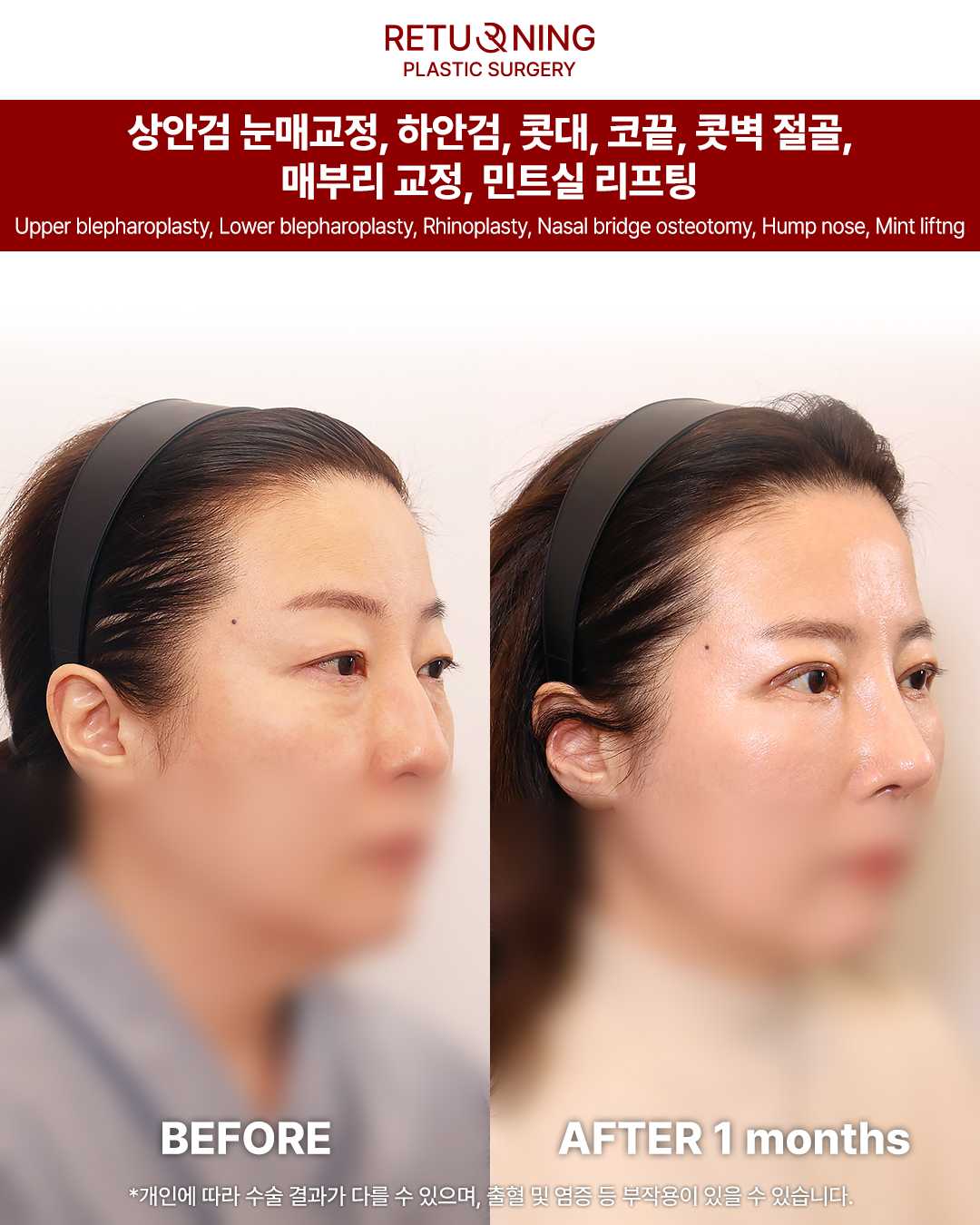 Операция на носу. Изображение до и после.