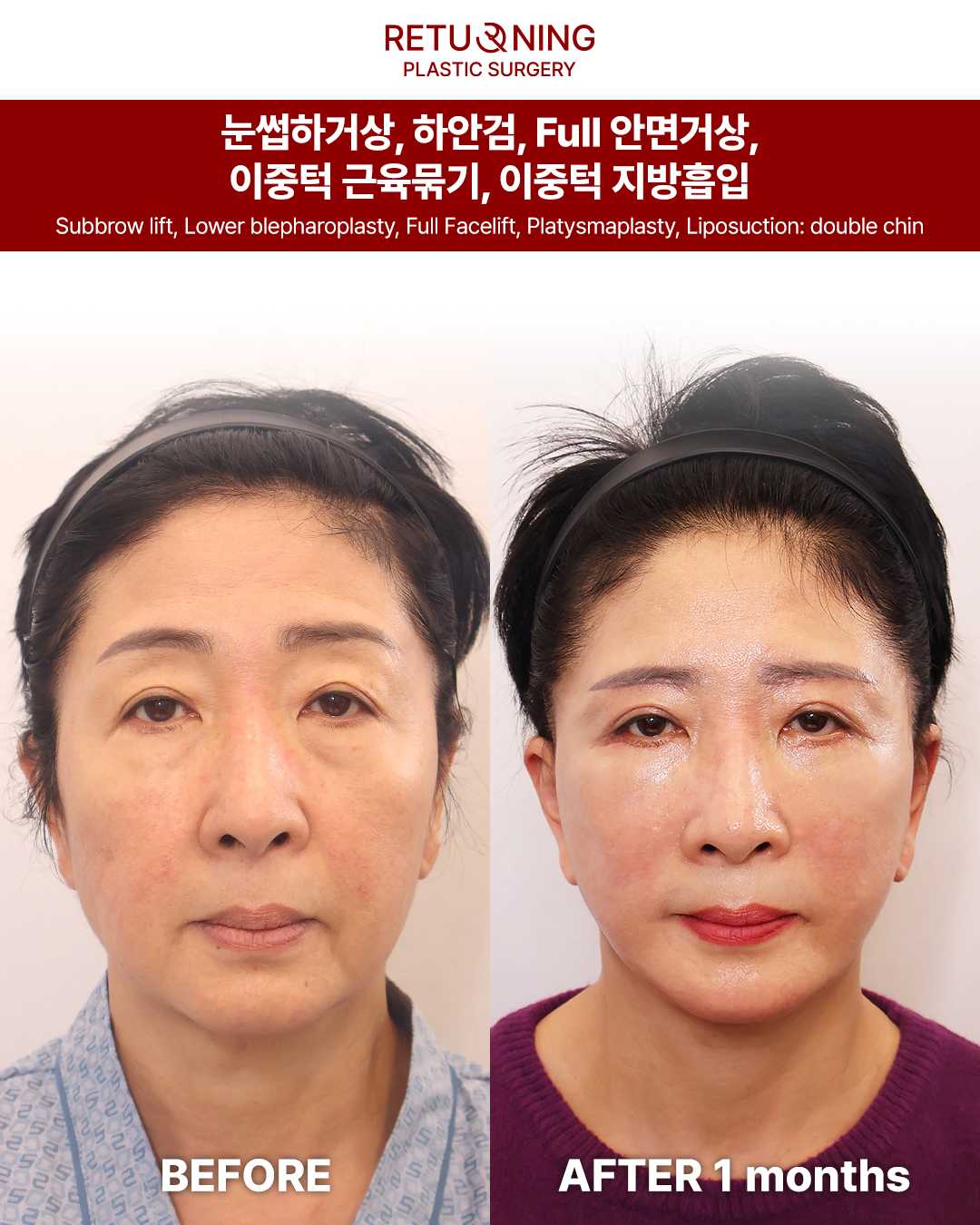 Операция на веках. Изображение до и после