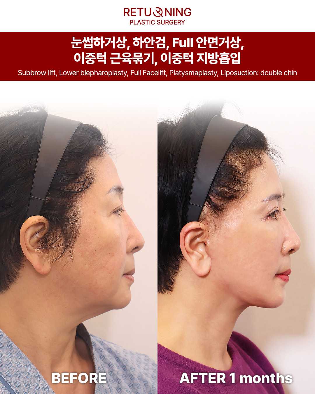 Операция на нижнем веке. Изображение до и после