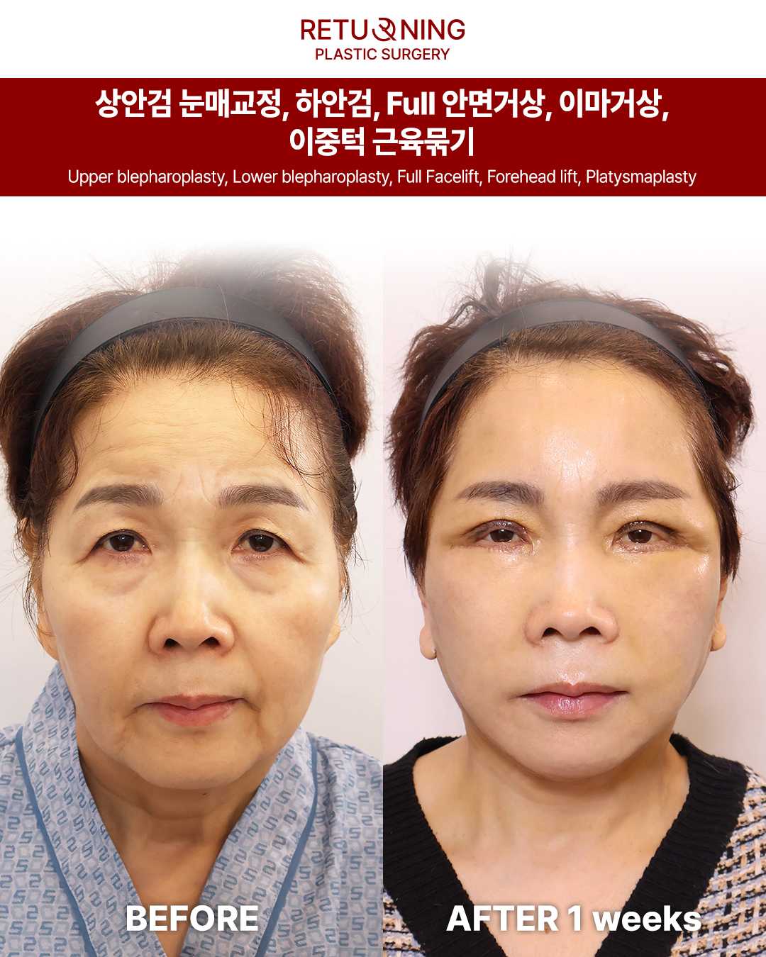 Полная подтяжка лица. Изображение до и после