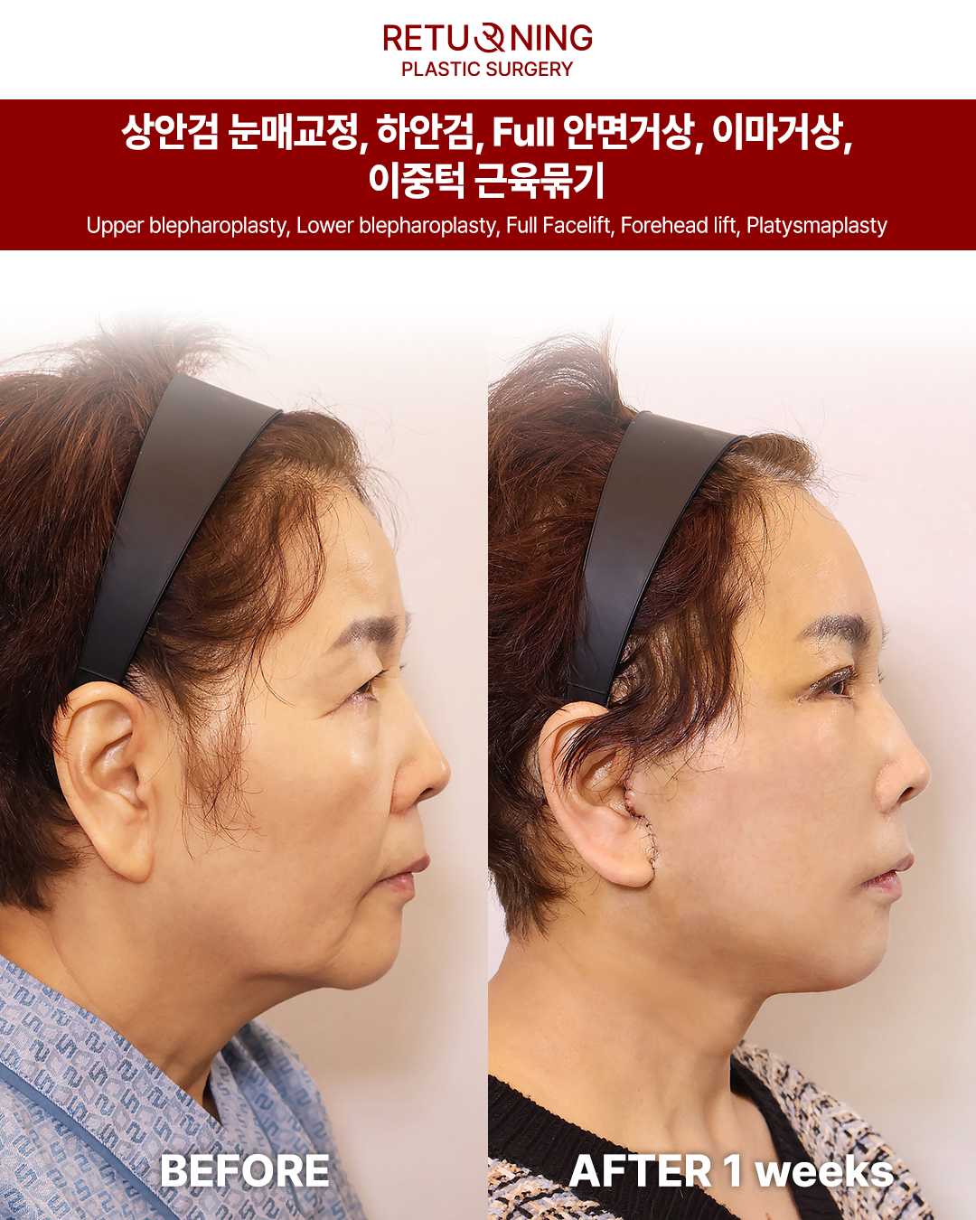 Операция по подтяжке лица Изображение до и после