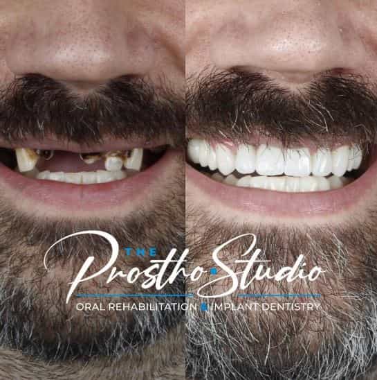 Antes y después de All on 4 implantes dentales en Los Algodones, México