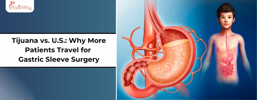 Tijuana vs. EE. UU. ¿Por qué más pacientes viajan para la cirugía de manga gástrica?