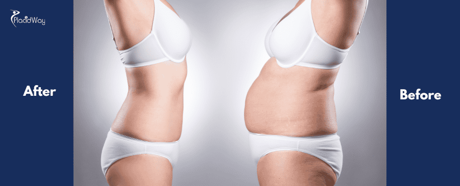 Side-by-side comparison of a woman's tummy tuck in tijuana. The left shows a flatter stomach labeled 
