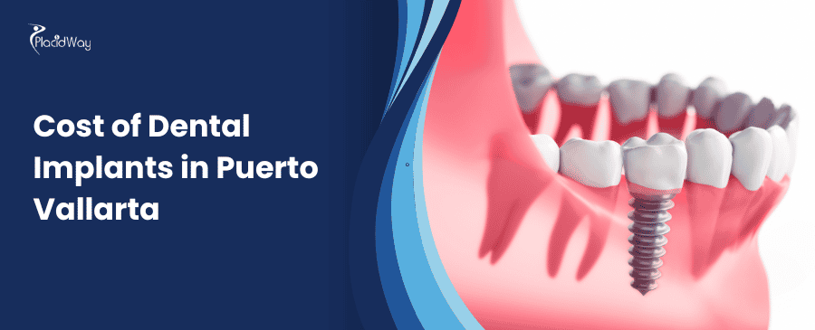 costo de los implantes dentales en Puerto Vallarta