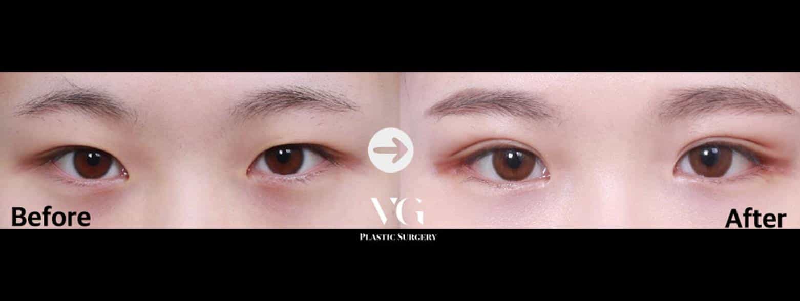 قبل وبعد جراحة الجفن في سيول، كوريا الجنوبية