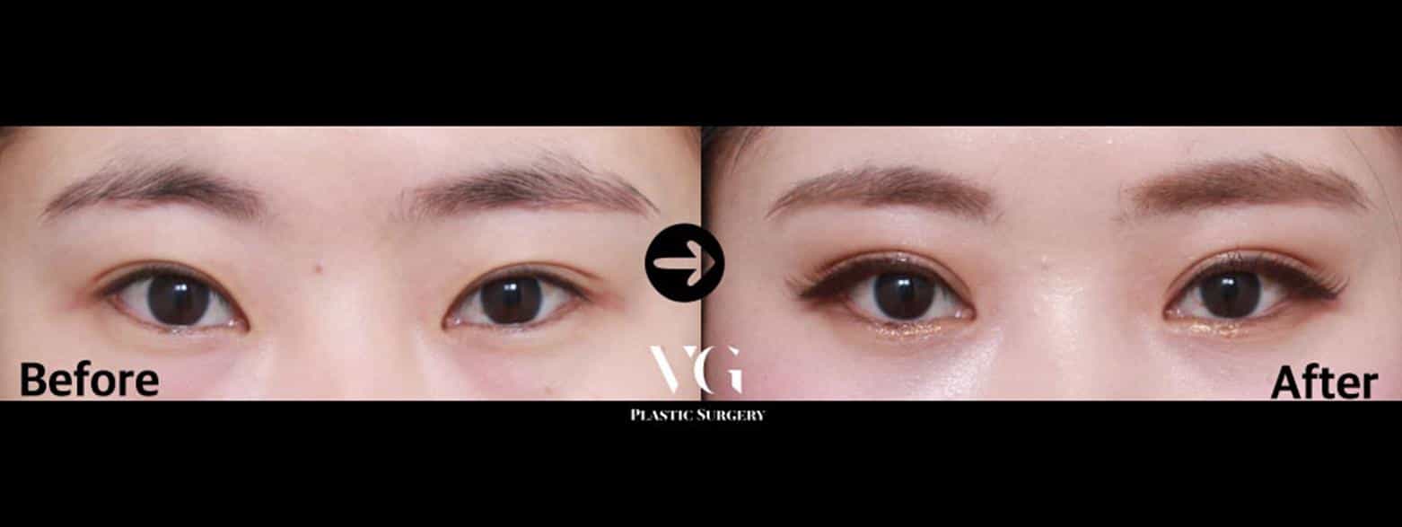 قبل وبعد جراحة الجفن في سيول