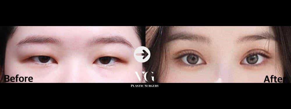 قبل وبعد جراحة الجفن في كوريا الجنوبية