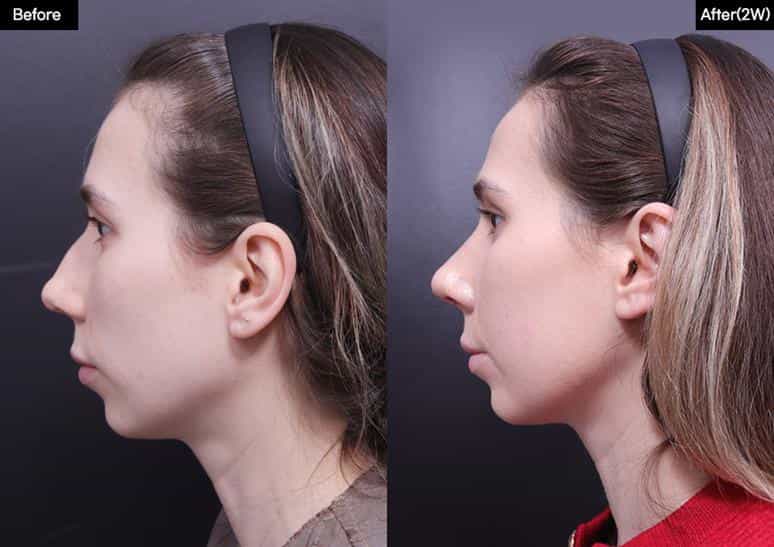قبل وبعد عملية تجميل الأنف في سيول، كوريا الجنوبية