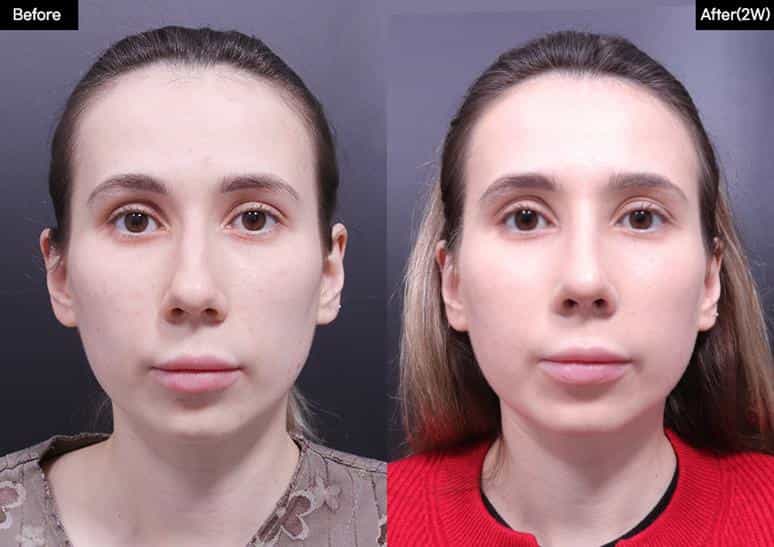 قبل وبعد عملية تجميل الأنف في سيول