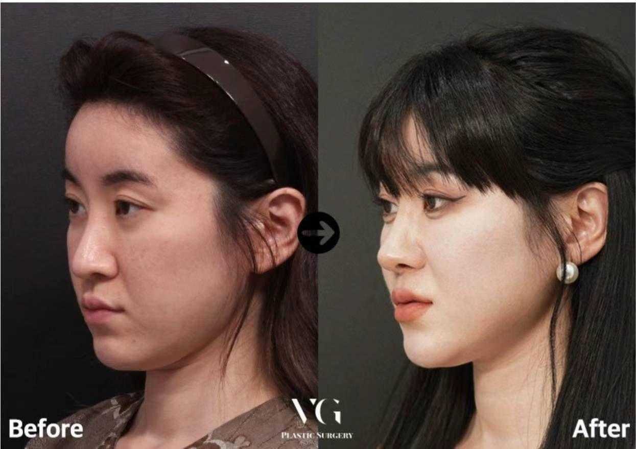 قبل وبعد عملية تجميل الأنف في كوريا الجنوبية