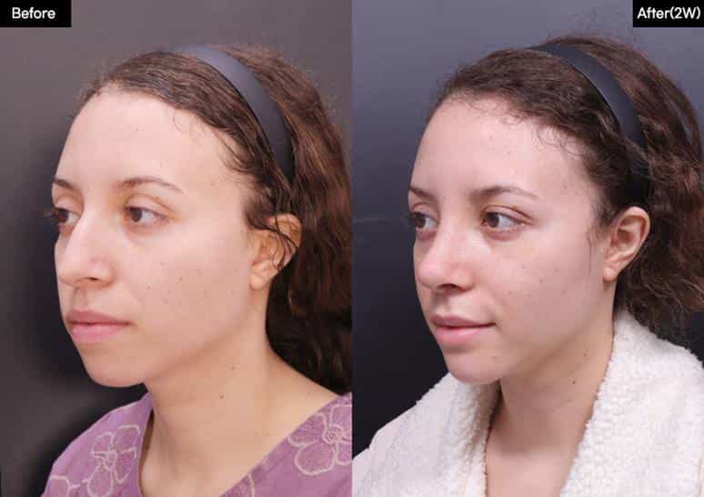قبل وبعد عملية تجميل الأنف في سيول، كوريا الجنوبية