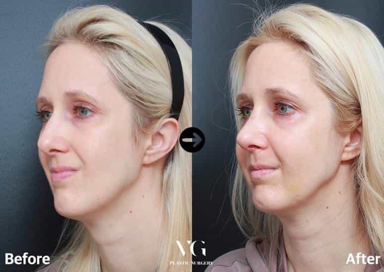 قبل وبعد جراحة الأنف في سيول، كوريا الجنوبية