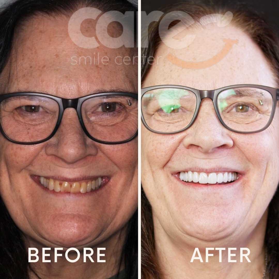 Antes y después del blanqueamiento dental en Los Algodones, México