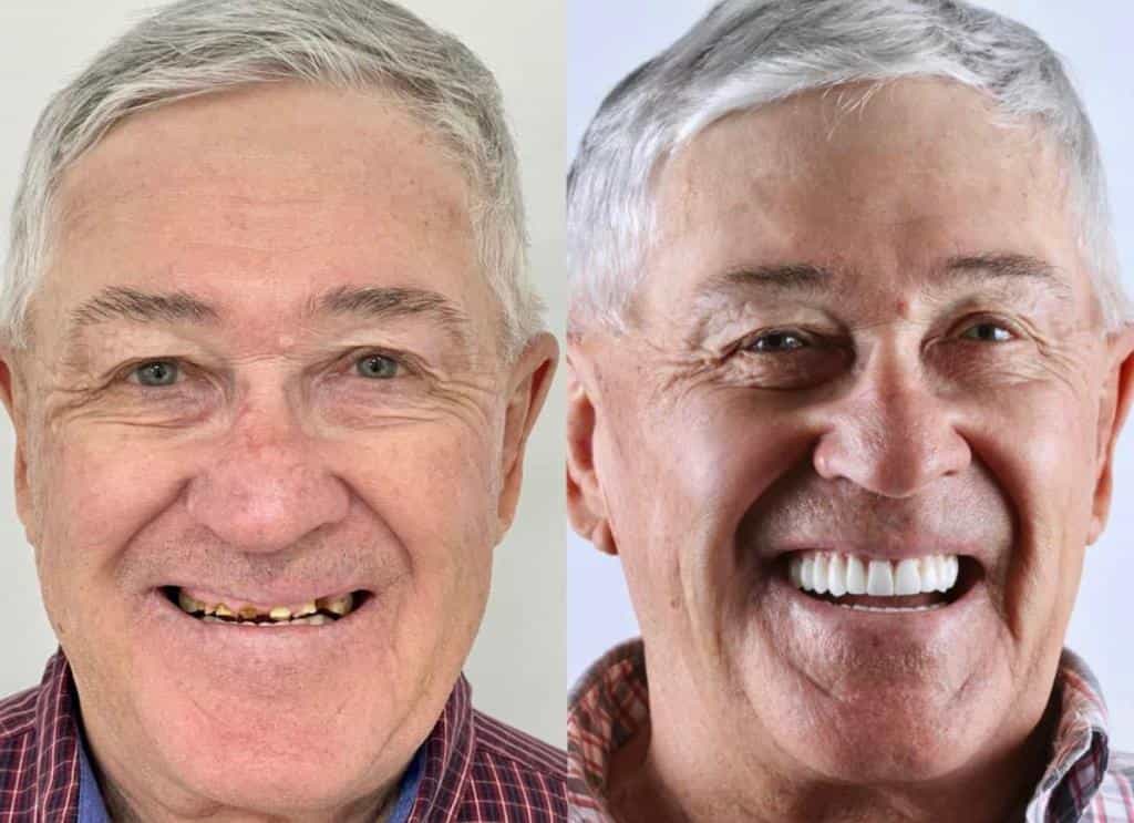 Antes y después de implantes dentales en Los Algodones, México